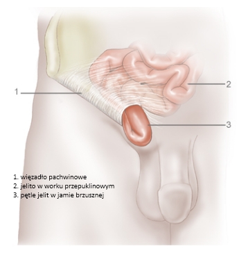 czci przepukliny