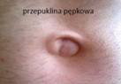 przepuklina-pepkowa2