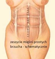 zeszycie-miesni-prostych-w-tunelu-podskornym