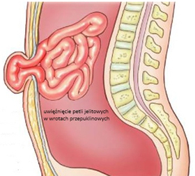 uwiezniecie-petli-jelitowych